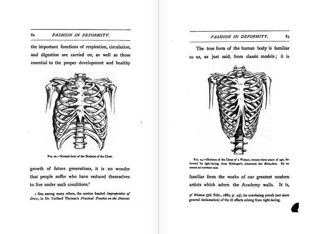 Medical effects of corset wearing. 1881 illustration showing how