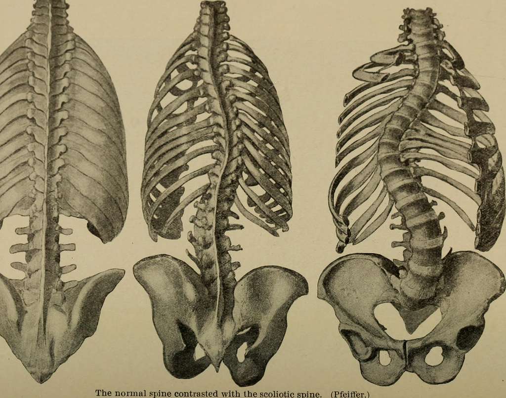 A treatise on orthopedic surgery . The Phelps hip splint. A chair