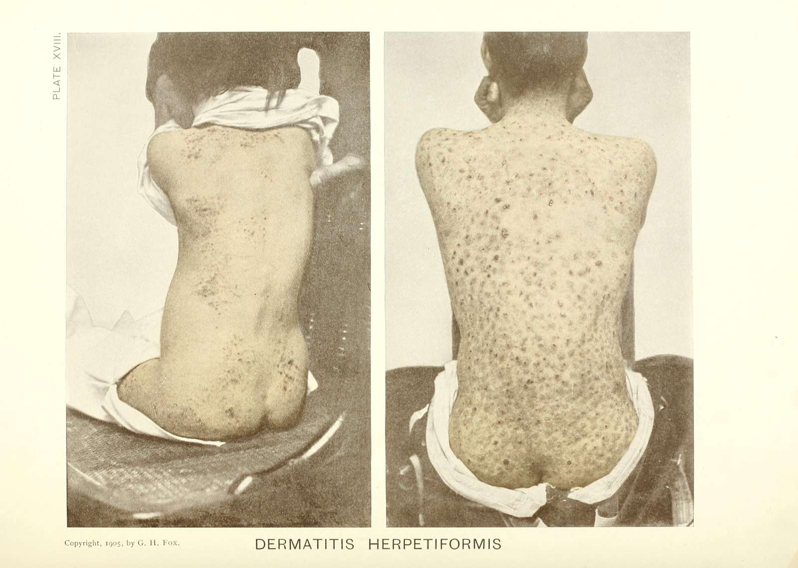 https://cdn2.picryl.com/photo/1905/12/31/photographic-atlas-of-the-diseases-of-the-skin-a-series-of-ninety-six-plates-d8667b-1600.jpg