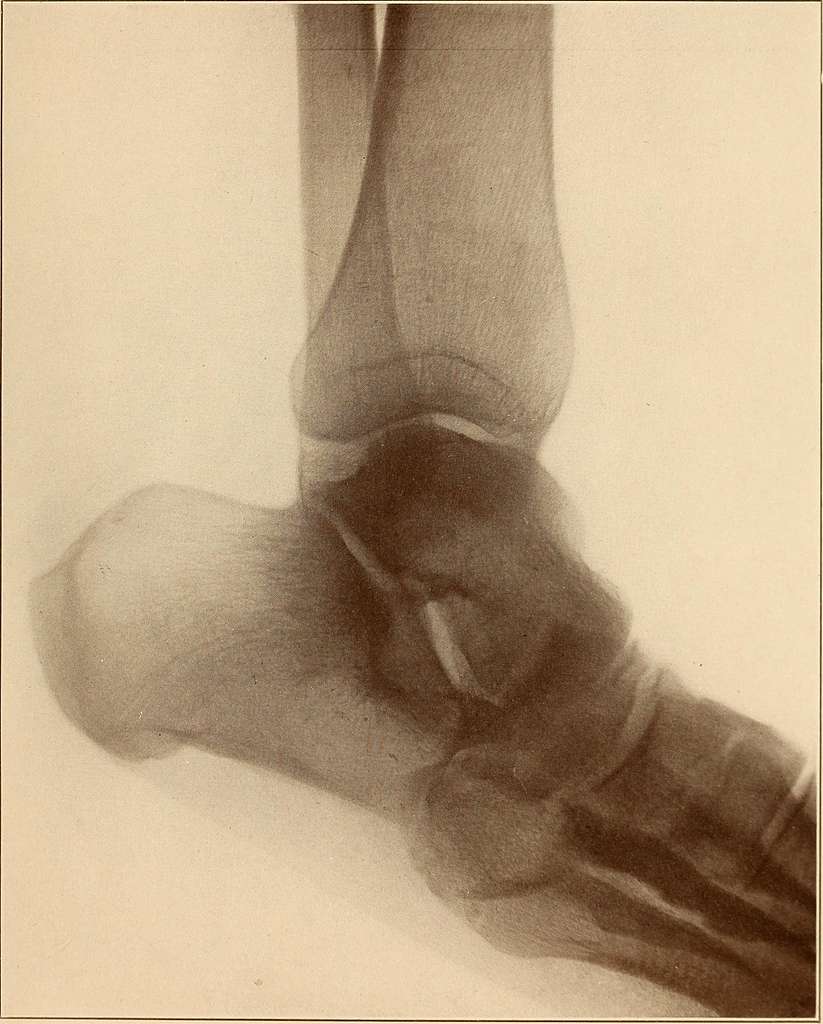 A practical treatise on fractures and dislocations . inside of the