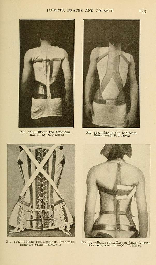 Scoliosis & Corsets: Can a Steel Boned Corset Help with Spinal
