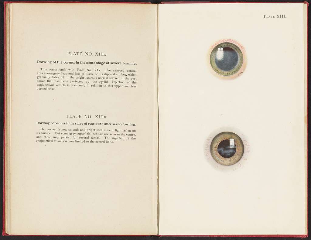 Plate XIII. A. Drawing of the cornea in the acute stage of severe ...