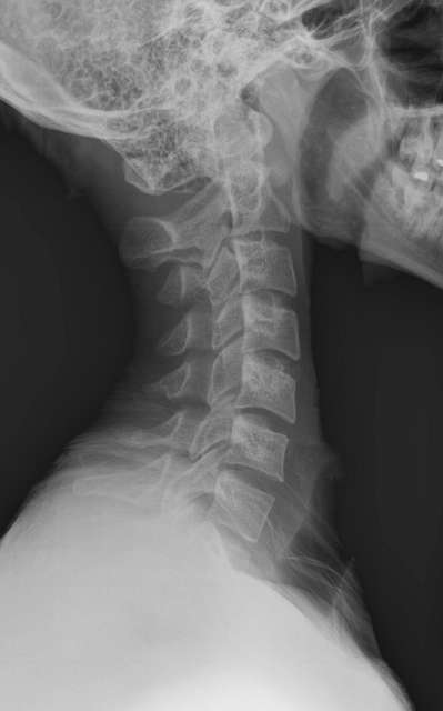 X-ray of the cervical spine of an 20 year old male - lateral, case 2 ...