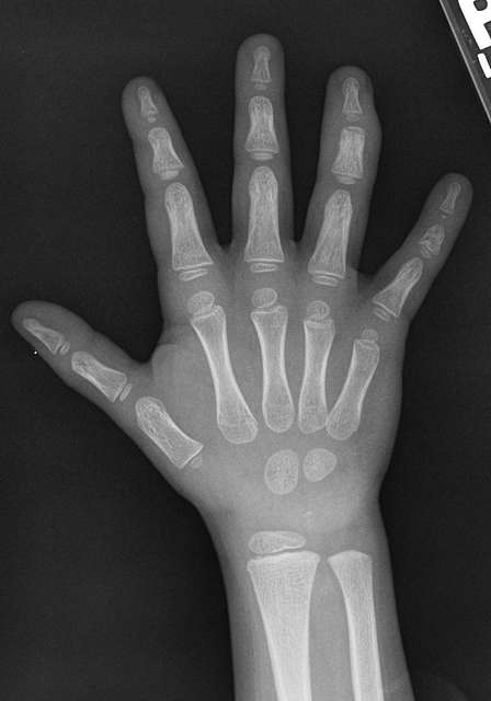 X-ray of the hand of a 4 year old male - dorsoplantar - PICRYL - Public ...