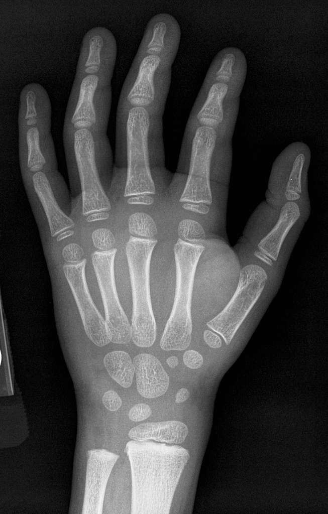 X-ray of the hand of a 5 year old male - case 2 - dorsoplantar - PICRYL ...