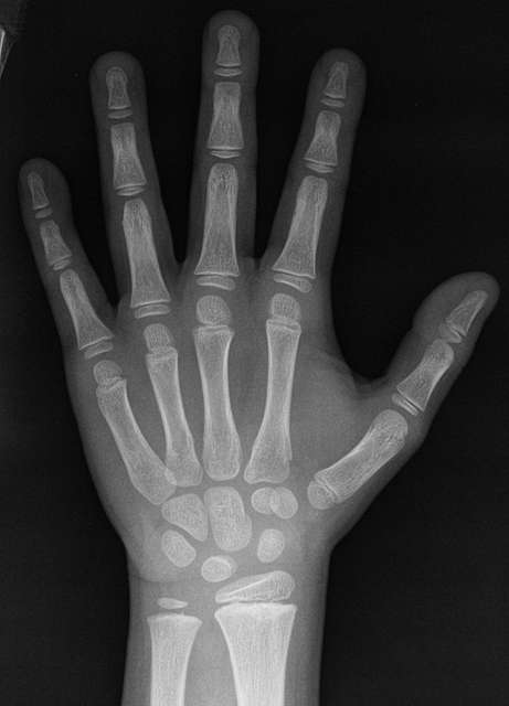 X-ray of the hand of a 7 year old male - case 2 - dorsoplantar - PICRYL ...