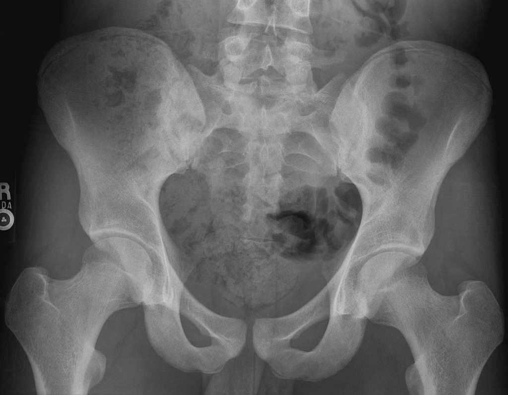 normal male hip arthritis xray