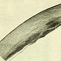 . Pathology and bacteriology [electronic resource]. Ophthalmology; Eye;  Eye; Bacteriology; Ophthalmology; Eye; Bacteriology; Eye. THE CORNEA 559  Tertiary syphilis rarely affects the lids and conjunctiva. Occasionally  gummatous ulcers may form on the