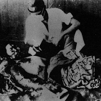 An Atomic Bomb Victim With Burns - 1 - Ninoshima Quarantine Office.