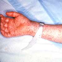 Rocky mountain spotted fever - PICRYL - Public Domain Media Search Engine  Public Domain Search